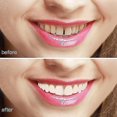 thumbnail image 2 of Instant Smile Comfort Fit Flex Teeth Whitening Denture Paste Cover, 2 of 3