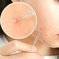 thumbnail image 5 of Penkiiy Blackhead Remover Tool, Pimple Popper Tool Kit, Blackhead Extractor Tool for Face, Extractor Tool for Comedone Zit Acne Whitehead Blemish, Stainless Steel Extraction Tools, 5 of 5