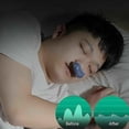 thumbnail image 2 of Dispositivo antirronquidos de ruido micro eléctrico Apnea del sueño Stop Snore Aid Stopper.blue,11 Feliz Sencillez, 2 of 5