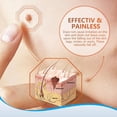 thumbnail image 4 of Crema eliminadora de lunares para rostro y cuerpo: ungüento eficaz para eliminar verrugas para todo tipo de piel, 4 of 8