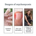 thumbnail image 3 of Nail Fungus Treatment for Toenails, Toenail Fungus Treatment, Extra Strength Nail Fungus Treatment For Fingers & Toenai, 3 of 5