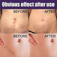 thumbnail image 5 of Silicone Scar Stickers Dilute Scars Caesarean Section Surgery Scar Hyperplasia Scar Silicone Repair Sticker, 5 of 5