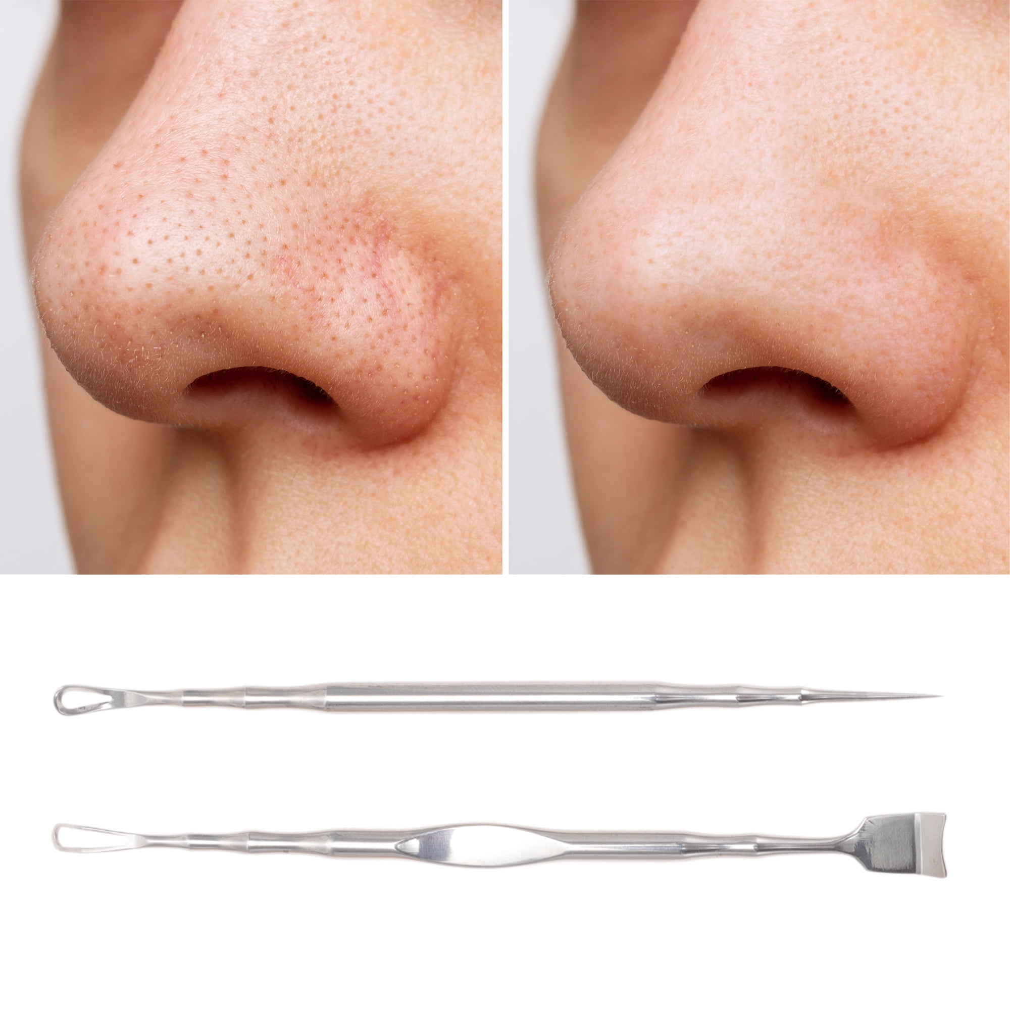 Unique Bargains 2pcs Pointed Pimple Extractor Tools for Skin Care Silver Tone 4.92"