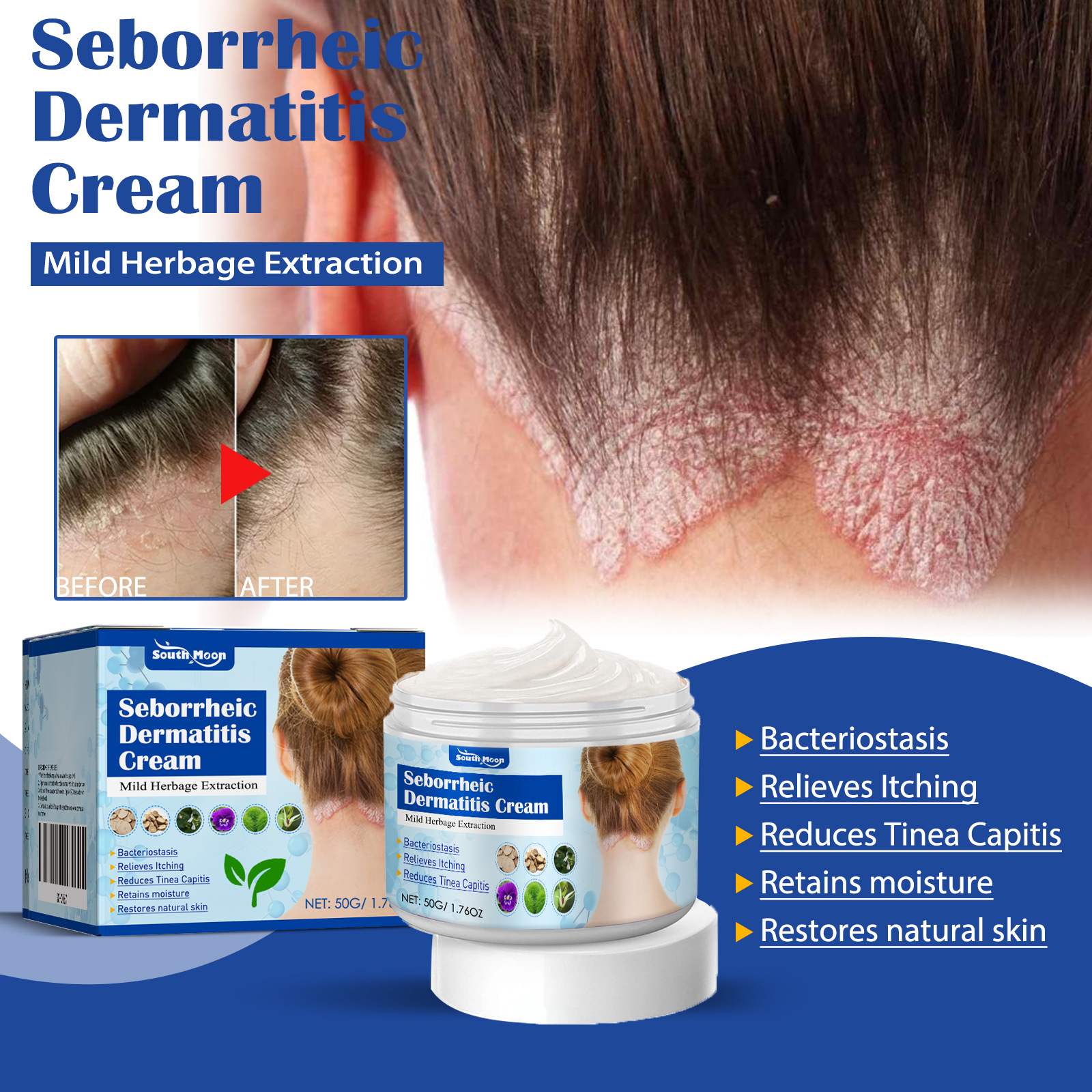 Seborrheic Dermatitis Cream，Seborrheic Skin Cream, Scalp Moss, Head ...