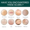 thumbnail image 4 of Medical grade silicone scar sheet, silicone scar tape, 4 of 5