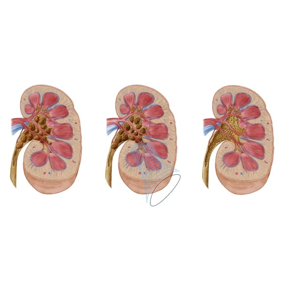 Urine Strainer Kidney Stones