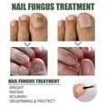 thumbnail image 4 of EELHOE 30ml Nail Fungus Treatment Solution Extracts Remove Onychomycosis No Yellowing Restore Shine, 4 of 5