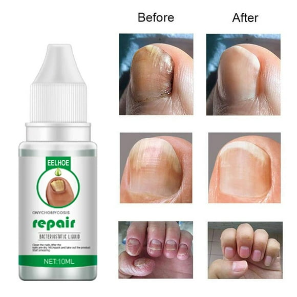 Nail Fungal Treatment Feet Care Essence Foot Repair Nail Fungus Removal Serum Gel Anti Infection Paronychia Onychomycosis