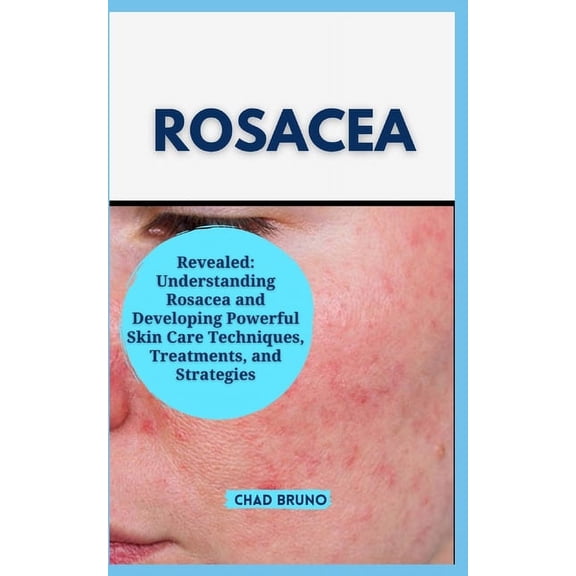 Rosacea: Revealed: Understanding Rosacea and Developing Powerful Skin Care Techniques, Treatments, and Strategies (Paperback)