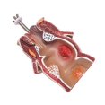 thumbnail image 4 of Modelo de AnatomíA, Modelo de LesióN de Hemorroides Rectales Humanos, FíStula de Hemorroides, , Modelo de EnseñAnza de PatologíA, 4 of 8