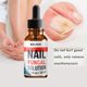 thumbnail image 1 of Juego De Reparación De Engrosamiento De Uñas Grises De Pata De Luna Sur O Esencia Antifúngica Para Pies De 30 Ml Limpieza Brillante Puntero Láser Matar Onicomicosis Sin Dolor Olor Batería Gao Jinjia unisex, 1 of 2