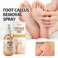 thumbnail image 2 of Xihbxyly Spray para Eliminar Callos En Los Pies, Solución Hidratante para El Cuidado de La Piel, Pies Suaves y Tersos, Mejora La Sequedad, Reduce La Aspereza, Limpia Los Poros, Envase Neto de 30 Ml,, 2 of 7