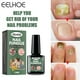 thumbnail image 1 of Líquido Para Hongos En Las Uñas Líquido Para El Cuidado De Hongos En Las Uñas, 15Ml, Reparación De Esencia De Uñas, Reparación De Cutículas De Uñas De Los Pies Dañadas Ndcxsfigh  Cuidado Belleza, 1 of 3