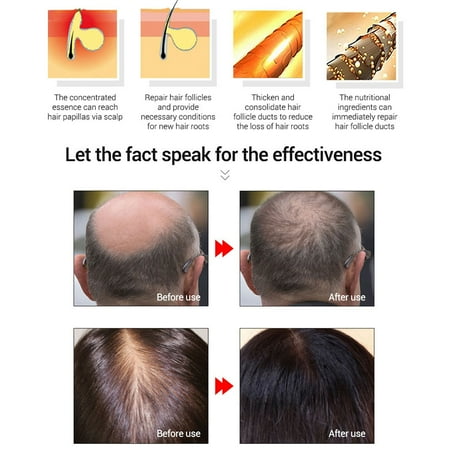 Garosa Hair Growth Serum Hair Loss Hair Thinning Treatment