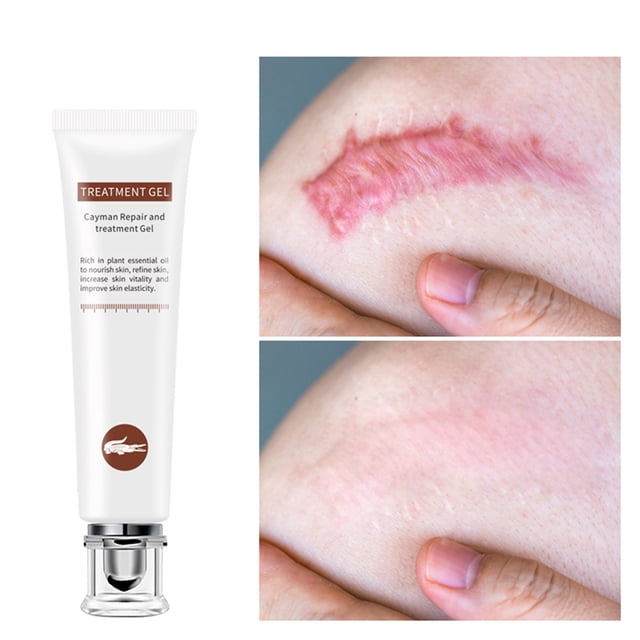 Crema Para Cicatrices Crema Para Estrías No Irritante Eliminación De Cicatrices Para La Cara O El Cuerpo ANGGREK No