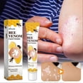 thumbnail image 5 of portable anti-itch cream for vitiligo skin care, 5 of 5
