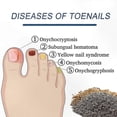 thumbnail image 3 of Fungal Nail Treatment Patches for Onychomycosis Repair, 3 of 5