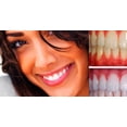 thumbnail image 3 of Expertwhite Extreme 44% Teeth Whitening Gel (6-gels) Free Shipping, 3 of 5