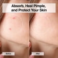 thumbnail image 4 of Pimple Patch FreeGo XOXO Hydrocolloid 120 unidades de ácido salicílico, 4 of 8