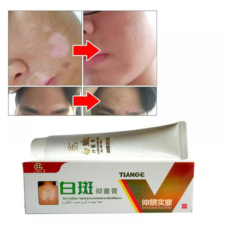 Praktisk Bør Praktisk Prettyui Chinese Medical White Spot Disease Cream Pigment Melanin Promoting  Liniment Skin Vitiligo Leukoplakia Disease Treatment 30g - Walmart.com