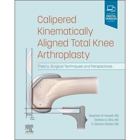 Calipered Kinematically aligned Total Knee Arthroplasty