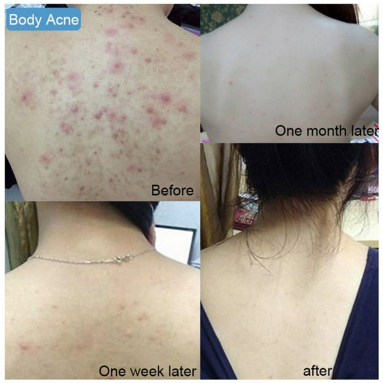 Nuriskin acne 2024