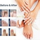 thumbnail image 4 of Fungal Nail Treatment For Toenails Extra Strong,nail Fungus Treatment For Toenail,toenail Fungus Treatment, 4 of 5