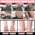 thumbnail image 4 of Máquinas Exfoliadoras Labg Removedor De Callos Dorado, 4 of 5