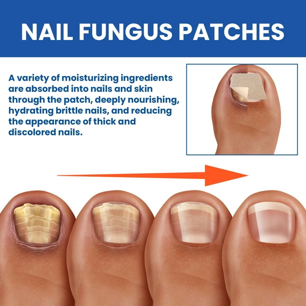 XIMONTH Nail Fungus Treatment for Toenail, 32 Pcs Nail