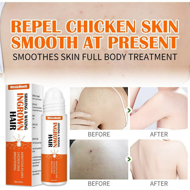 Bilqis Deals Crème d'Épilation Arrête-Bosse Poils Incarnés Rasage Réduire Taches Brûlures Rougeurs Solution 20 ml