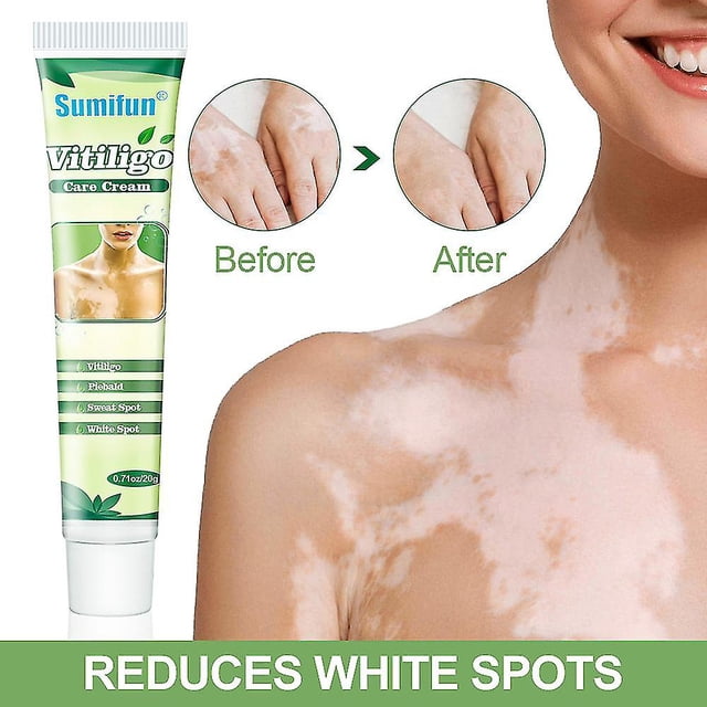 Crema de tratamiento White Tag para reducir las manchas blancas de la piel y el cuidado de la piel con vitíligo. Afortunado Sencillez