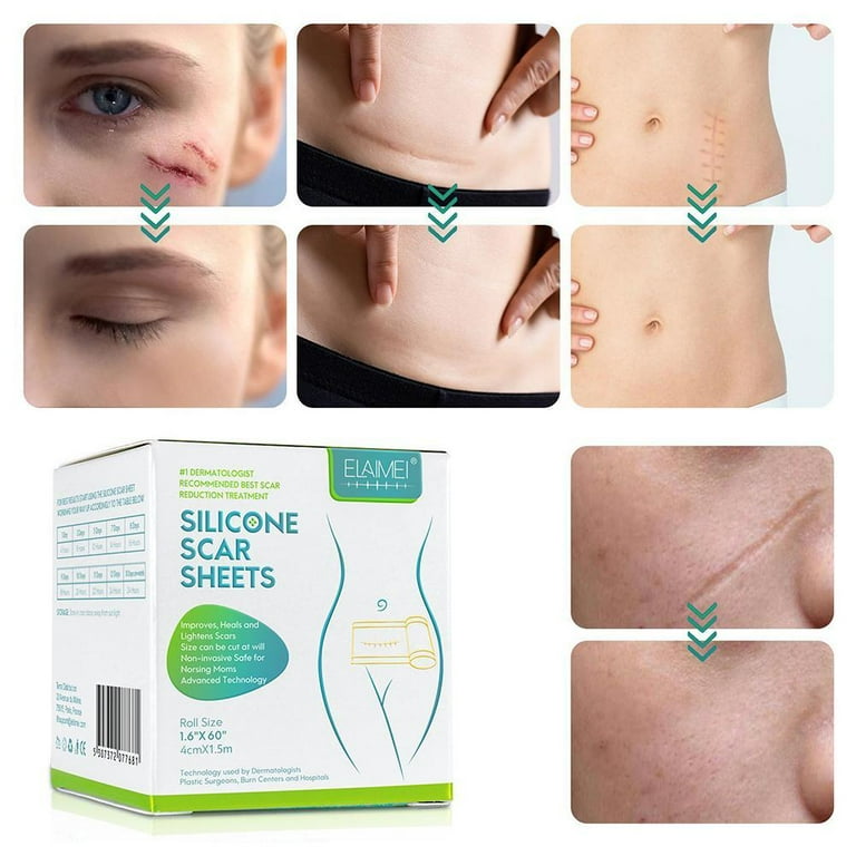 4cm 1 5m Surgery Scar Removal Sticker Sheet Patch Silicone Gel