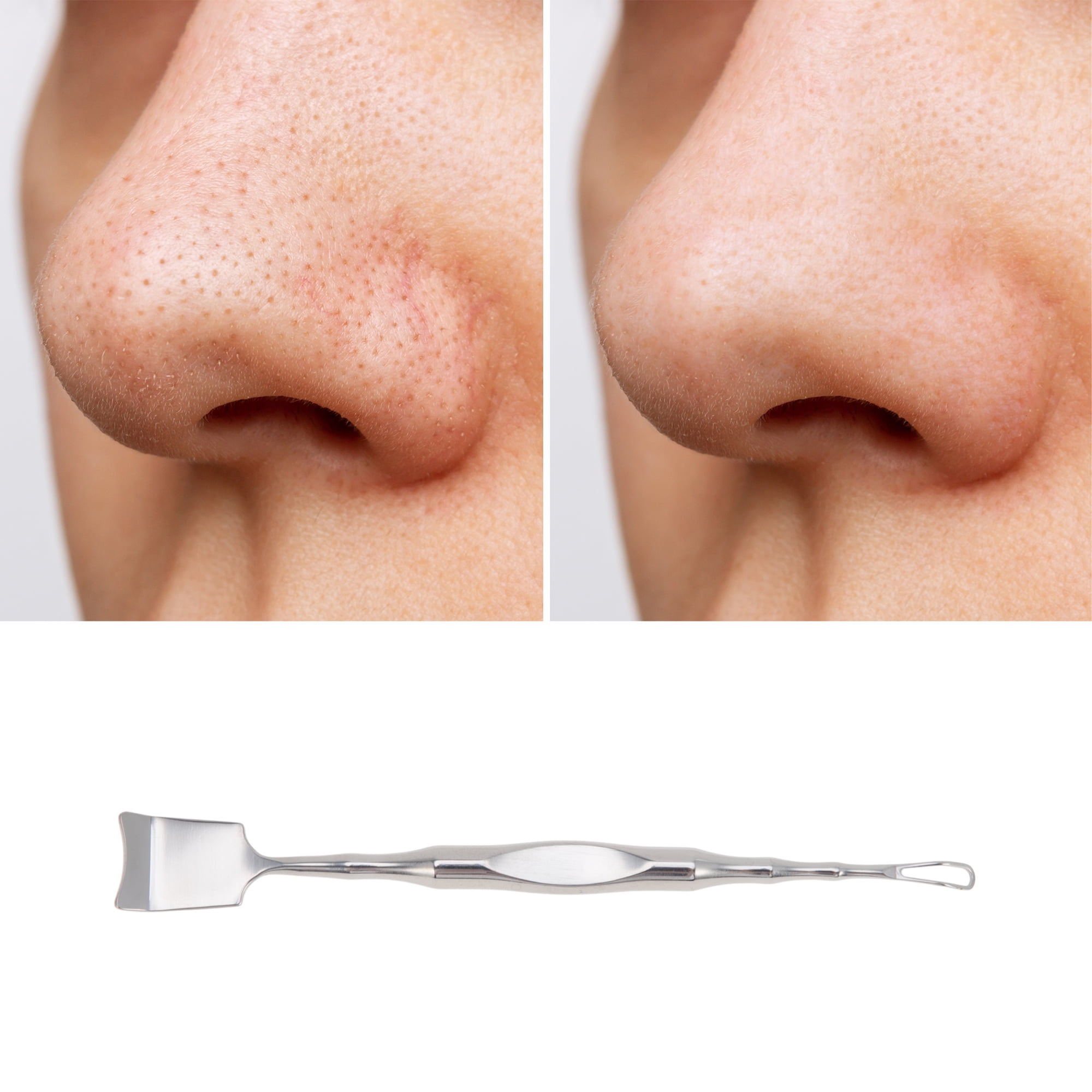 Unique Bargains Convenient Durable Pimple Extractor Silver Tone 1 Pc Large