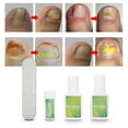 thumbnail image 1 of Juego De Herramientas De Pedicura Profesional Para Uñas, Recortador De Uñas Encarnadas, Fijador De Corrección Para El Cuidado De Los Pies, 1 of 7