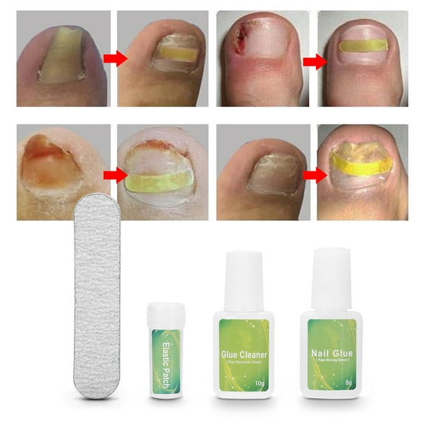 Juego De Herramientas De Pedicura Profesional Para Uñas, Recortador De Uñas Encarnadas, Fijador De Corrección Para El Cuidado De Los Pies