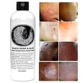 thumbnail image 5 of Acne, Eczema, Psoriasis, Face, Body, Dark Spot Remover - Men Women  Natural Black Soap with Aloe  - This Soap Works, 5 of 8