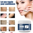 thumbnail image 2 of Crema para eliminar cicatrices de acné, manchas, espinillas, quemaduras, cicatrices quirúrgicas, tratamiento de estrías, reparación, blanqueamiento, hidratación, cuidado de la piel, 2 of 5