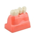 thumbnail image 4 of Dental Implant Model for Patient Education, 4 Times Dental Implant, 4 of 7