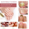 thumbnail image 4 of B Lápiz reparador de uñas con luz azul, tratamiento de hongos para uñas, crema nutritiva, antirestauración de uñas de los pies saludables, reparación de infecciones por hongos, 4 of 5