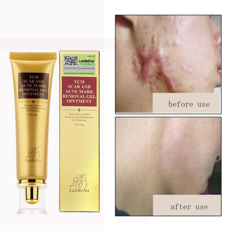 products for acne marks removal