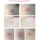thumbnail image 5 of Parches antiacné 180 piezas hidrocoloides para espinillas, 5 of 5