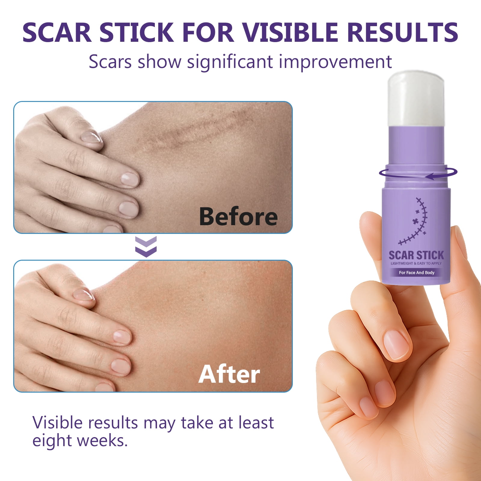 Keloid Bump Removal, Silicone Scar Gel for Keloid Scar Treatment, Acne Scar Treatment, and Scar Cream for Surgical Scars
