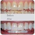 thumbnail image 4 of Cepillo de dientes eléctrico para adultos - Cepillo de dientes ultrasónico en forma de U - Limpieza bucal de 360 grados - Carga inalámbrica y luz LED - (rosa), 4 of 5