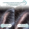 thumbnail image 3 of Seborrheic Dermatitis Psoriasis Shampoo-Refreshing, anti-dandruff, anti-itching and firm hair, 3 of 4