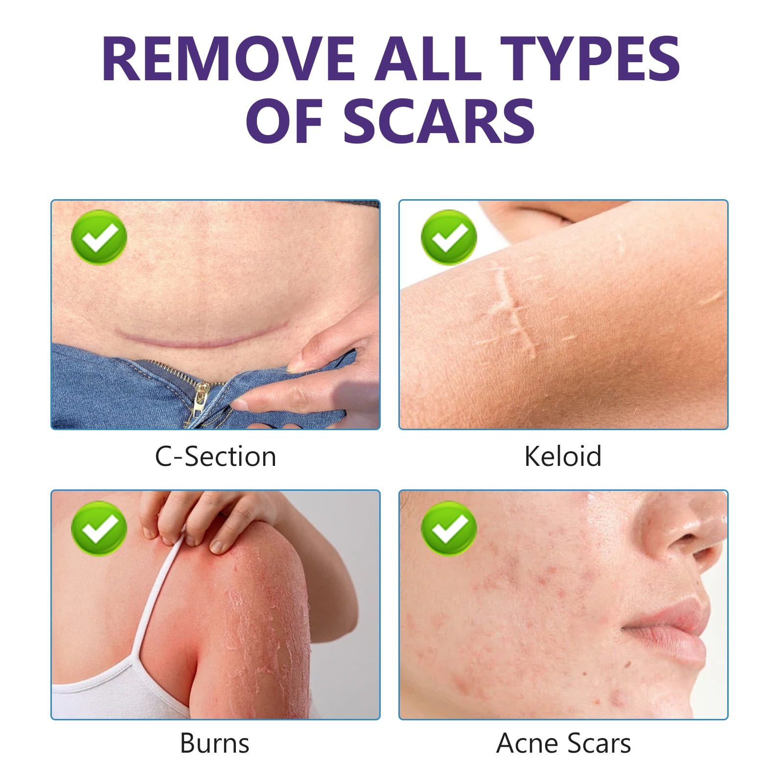 Keloid Bump Removal, Silicone Scar Gel for Keloid Scar Treatment, Acne Scar Treatment, and Scar Cream for Surgical Scars