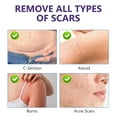 thumbnail image 5 of Keloid Bump Removal, Silicone Scar Stick, Silicone Scar Gel for Keloid Scar Treatment, Acne Scar Treatment, and Scar Cream for Surgical Scars, 5 of 9