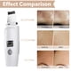 thumbnail image 5 of Depurador de piel facial Minnieouse Pantalla ABS espátula profunda para espinillas y acné, 5 of 6