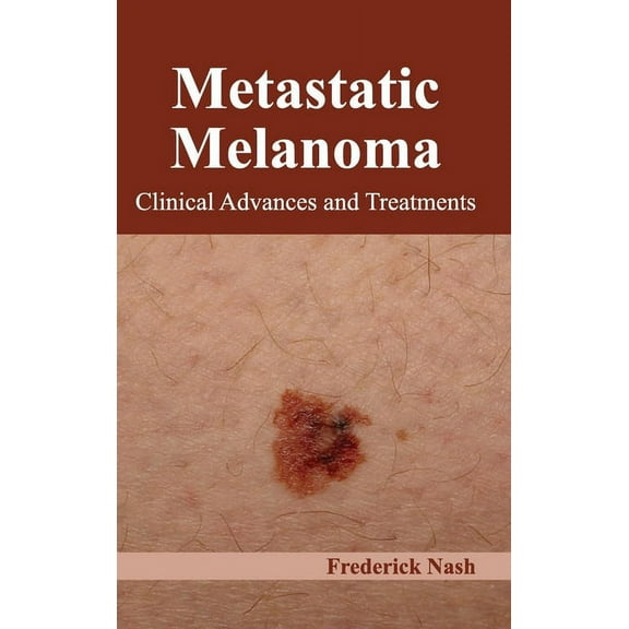 Metastatic Melanoma: Clinical Advances and Treatments, (Hardcover)