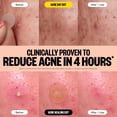thumbnail image 4 of Pimple Patches PEACE OUT Acne Dúo para día y noche, 20 puntos, 4 of 9