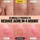 thumbnail image 4 of Pimple Patches PEACE OUT Acne Dúo para día y noche, 20 puntos, 4 of 9